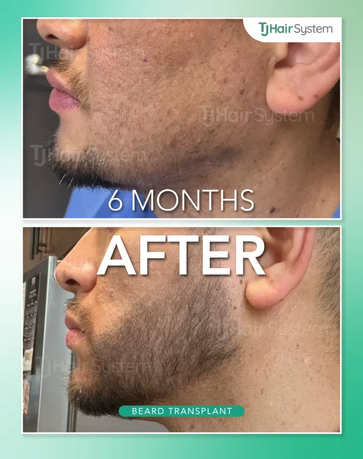Jawline & chin, hair transplant before and after, 6 months · dark hair