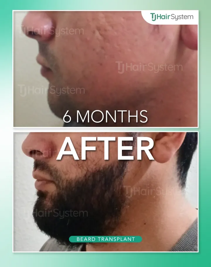 Full beard, hair transplant before and after, 6 months · dark, thick hair