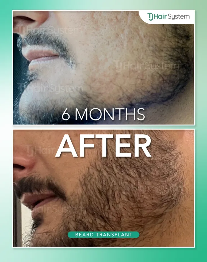 Cheeks & jaw, hair transplant before and after, 6 months · dark hair
