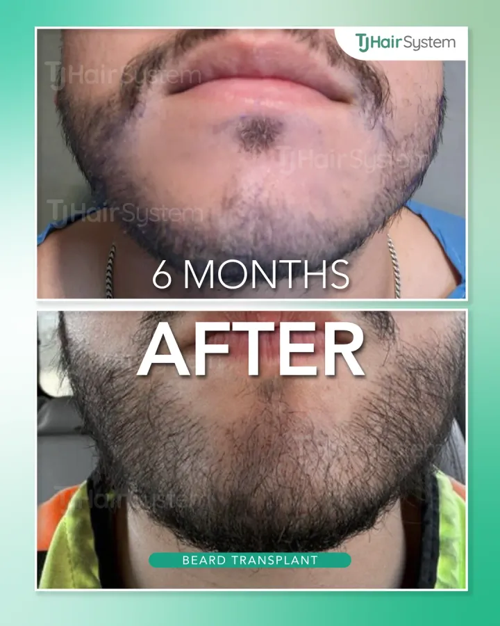 Chin & lower beard, hair transplant before and after, 6 months · dark, coarse hair