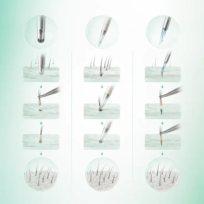 FUE, DHI and Sapphire: extraction and implantation step by step