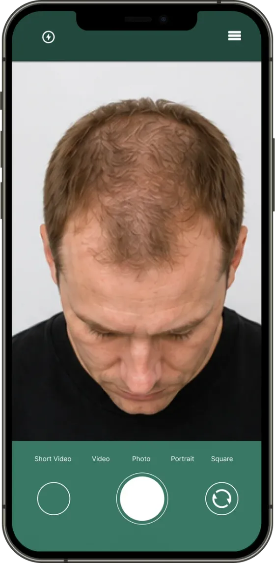 Example: Top of scalp, Men