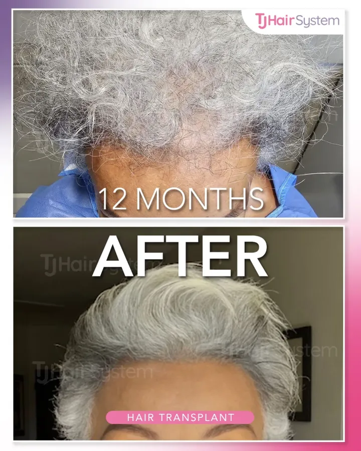 Overall density, hair transplant before and after, 12 months · coarse, gray hair