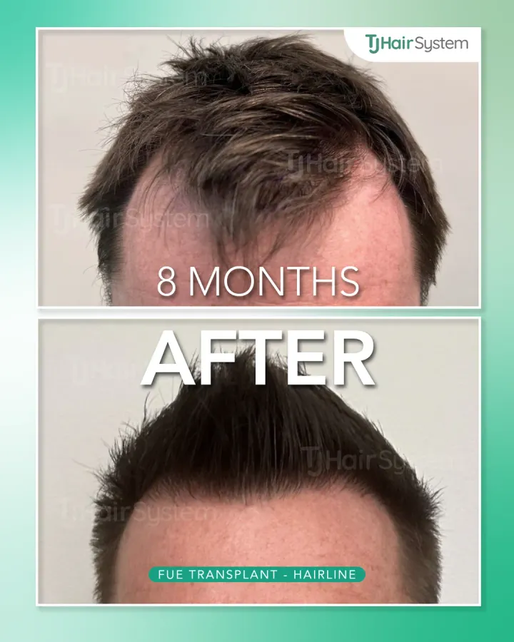 Temple points, hair transplant before and after, 8 months · straight, brown hair