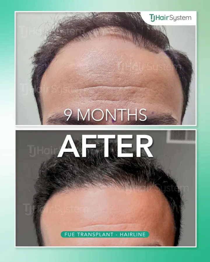 Front third of the scalp, hair transplant before and after, 9 months · straight, dark hair