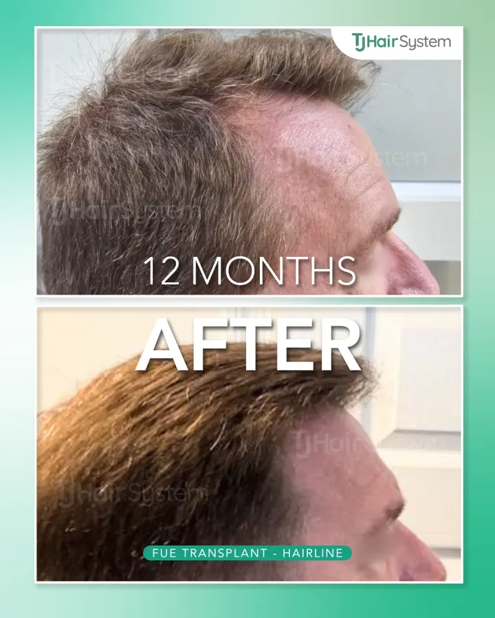 Temples & side profile, hair transplant before and after, 12 months · wavy, brown hair