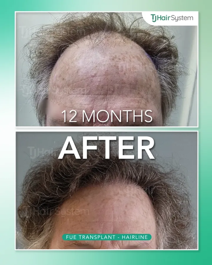 Frontal hairline & forelock, hair transplant before and after, 12 months · curly, brown hair