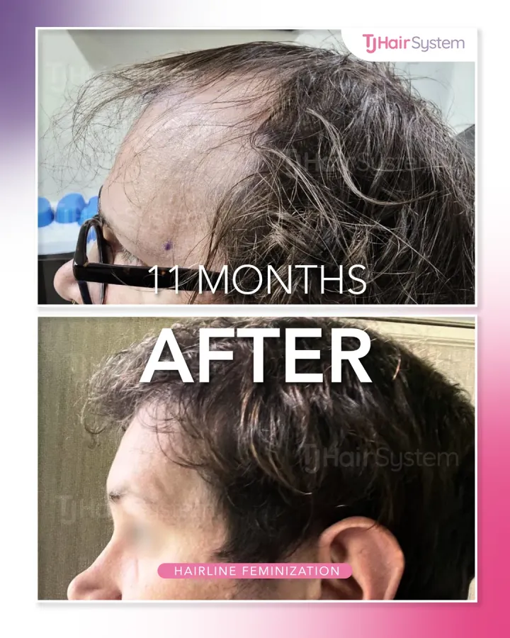 High hairline & temples, hair transplant before and after, 11 months · wavy, dark hair