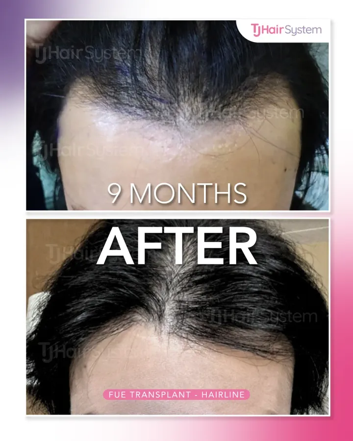 Hairline & part line, hair transplant before and after, 9 months · straight, black hair