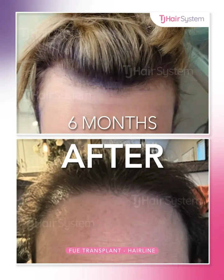 Receding frontal edge, hair transplant before and after, 6 months · straight, blond hair