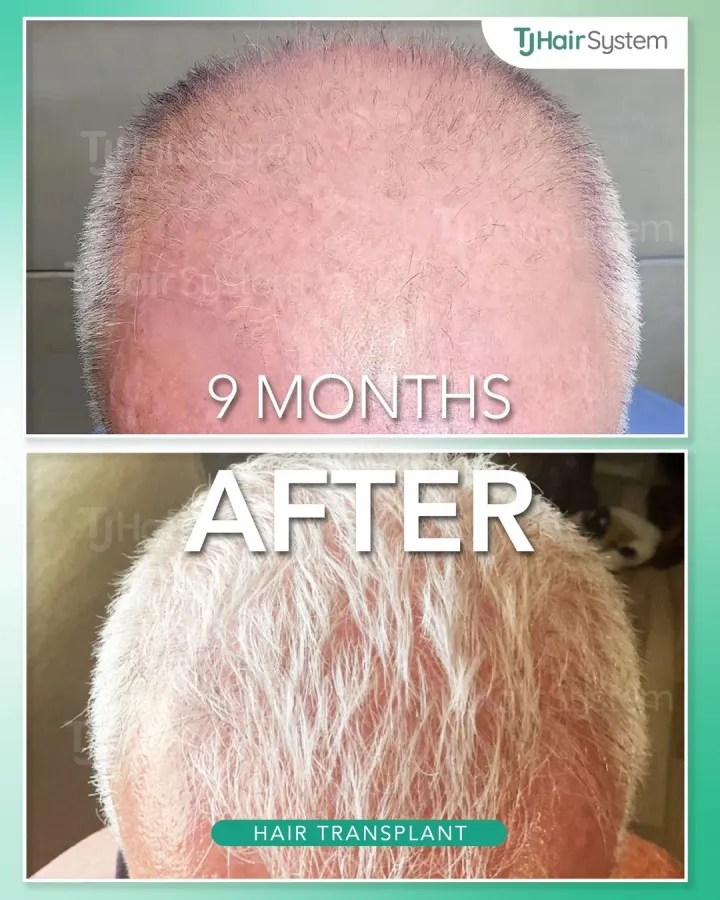 Crown & vertex, hair transplant before and after, 9 months · fine, white hair