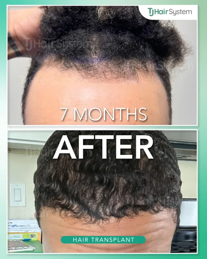 Frontal hairline, hair transplant before and after, 7 months · curly, dark hair