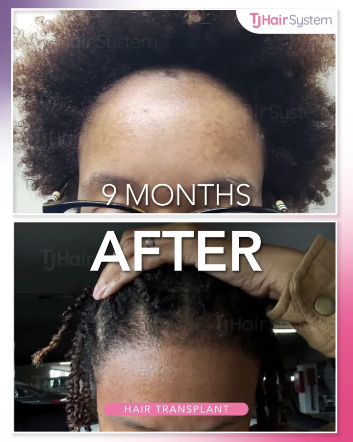 Frontal density, hair transplant before and after, 9 months · afro-textured hair