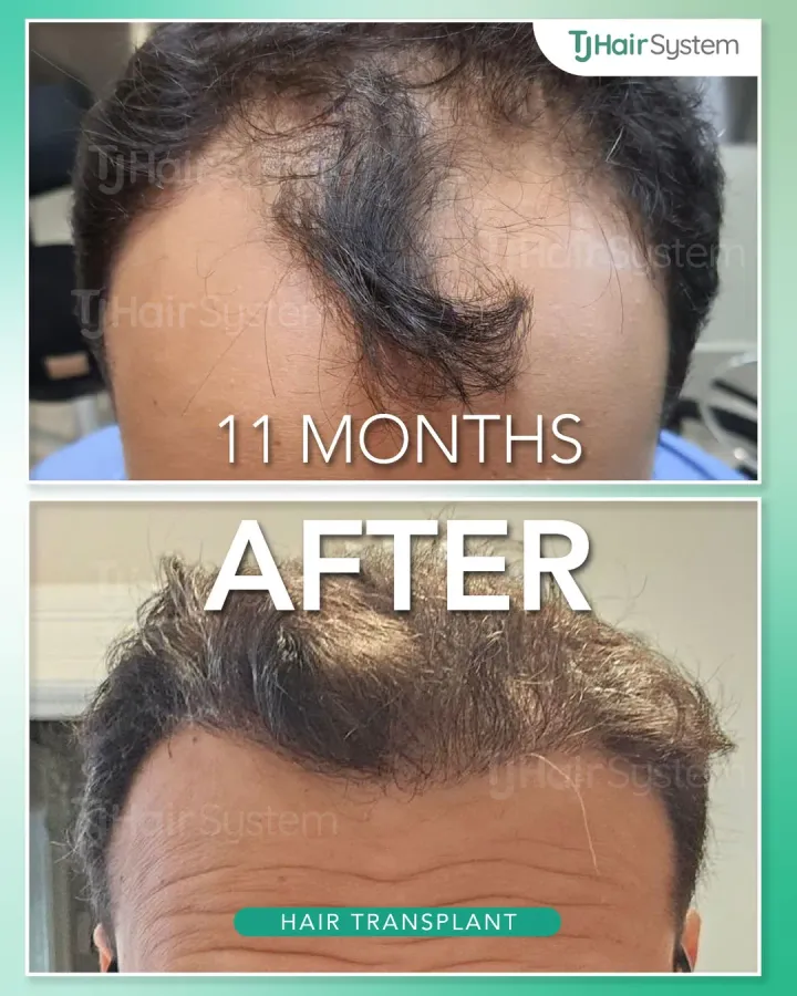 Frontal hairline & temples, hair transplant before and after, 11 months · straight, dark hair