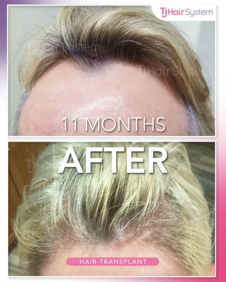 Hairline & temples, hair transplant before and after, 11 months · fine, blond hair