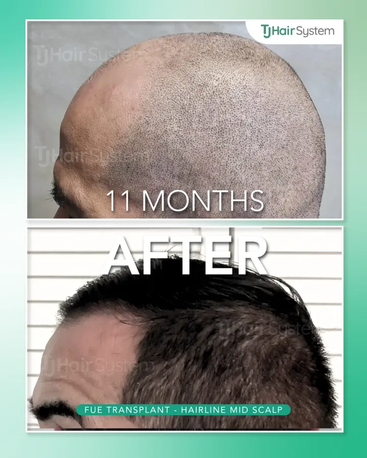 Hairline & mid scalp, hair transplant before and after, 11 months · straight, dark hair