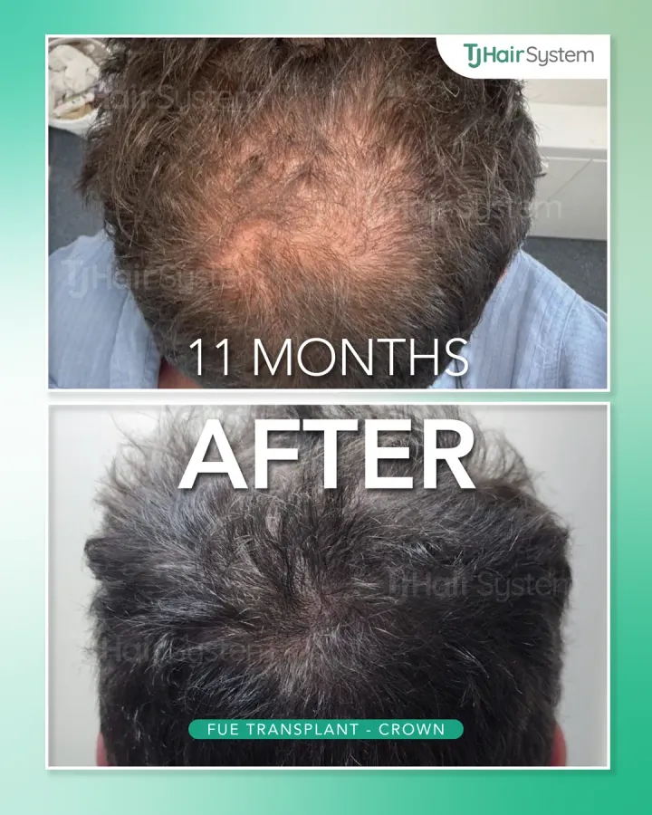 Crown, hair transplant before and after, 11 months · wavy, dark hair