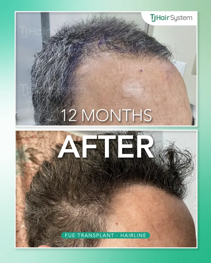 Receded frontal hairline, hair transplant before and after, 12 months · wavy, dark hair
